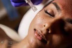 microneedling-3